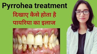 Pyrrohea treatmentपायरिया का इलाजपायरिया का इलाज कैसे होता हैमसूड़ों के बीमारी कैसे ठीक करे [upl. by Lee]