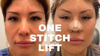 One Stitch Lift™ SCARLESS FACE LIFT [upl. by Levan536]