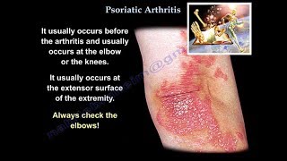 Psoriatic Arthritis  Everything You Need To Know  Dr Nabil Ebraheim [upl. by Gievlos]