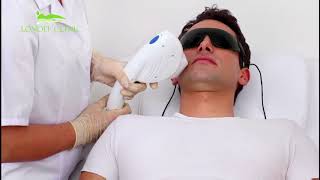 Depilazione Laser Londei Clinic [upl. by Elpmid]