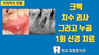 크렉 치수 괴사 누공 치아의 1회 신경 치료 판교최용훈치과 치아살리기 플라젠신경치료 [upl. by Malloch648]