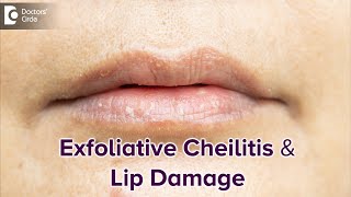 Exfoliative Cheilitis amp its effect on Lips  DRY LIPSBest TreatmentDrRasya Dixit Doctors Circle [upl. by Annahsal]