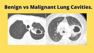 difference between malignant and benign lung cavities [upl. by Clausen596]