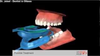 Preventive  Fluoride Treatment  Dentist Ottawa [upl. by Eillek]