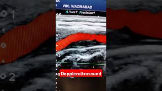 Carotid Dopplerultrasound [upl. by Cirdek689]