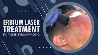 Erbium Laser Treatment for Skin Resurfacing  Beverly Hills CA [upl. by Arikat]