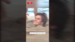 Teen Got Hookworms From Playing in Beach Sand shorts [upl. by Eded43]