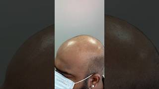 Scalp micropigmentation healed results of first session scalpmicropigmentationindia scalpdots [upl. by Karon]