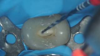 VDW Dental · Grande amp Plotino RECIPROC blue  Step by step preparation clinical video [upl. by Galatia]