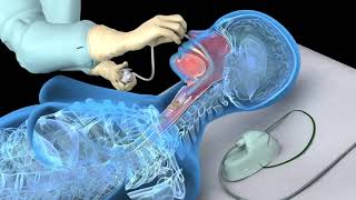 Nasotracheal suctioning NTS  3D animation [upl. by Arlin]