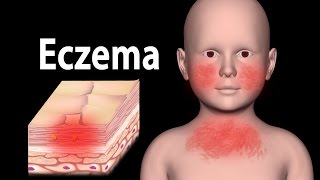 Eczema Animation [upl. by Cyndi954]