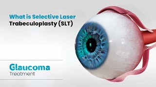 What is Selective Laser Trabeculoplasty SLT  Glaucoma Treatment 3D [upl. by Eldoria]