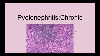 Chronic Pyelonephritis [upl. by Yespmed486]