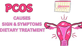 Polycystic Ovary Syndrome  PCOS  Causes  Sign  Symptoms amp Dietary Treatment [upl. by Liartnod]