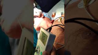 PNS guided mandibular nerve block3 [upl. by Ronnica]