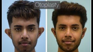 Dallas Otoplasty Before amp After [upl. by Cahn]