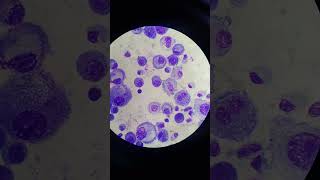 Mesothelial Cells in Pleural Fluid  Body Fluid  Fluids Giemsa Stain [upl. by Alue]