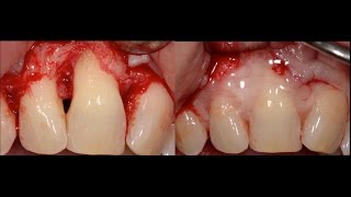 Periodontal Surgery with Emdogain [upl. by Sherborn216]