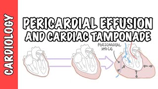 Cardiac Tamponade  pericardial effusion causes pathophysiology investigations and treatment [upl. by Araiet769]