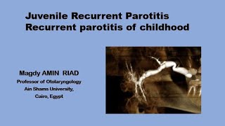 Juvenile Recurrent Parotitis Children Parotid inflammation [upl. by Ellehcil227]