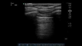 Lung ultrasound demonstrating the ABSENCE of lung sliding [upl. by Irakab]