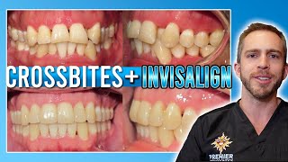 Invisalign Crossbite Treatment BEFORE amp AFTER [upl. by Ika]