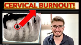 Cervical Burnout or Caries How to Know theories of dental caries in teeth cavity ICDAS x ray [upl. by Airelav]