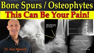 Bone SpursOsteophytes  This Can Be Your Pain  Dr Mandell [upl. by Lemej]