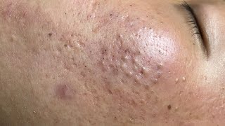 ACNE TREATMENT VU QUYNH MI  Blackheads Of Tweens 2024 EX [upl. by Luke]