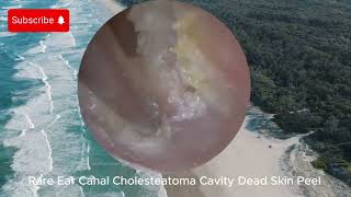 Rare Ear Canal Cholesteatoma Cavity Dead Skin Peel  EAR CLEANING [upl. by Browning]