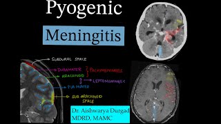 Pyogenic meningitis discussion Leptomeningeal enhancementDifferential diagnosis [upl. by Navek]