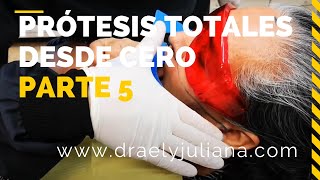 PRÓTESIS TOTALES👅Parte5 DimensiónVertical y Prueba de Rodillos en Cera [upl. by Drugi743]