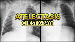 Atelectasis Chest X Ray Signs [upl. by Gala]