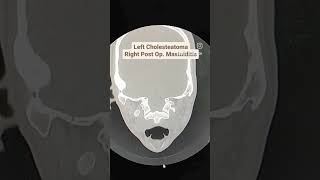 Cholesteatoma with Mastoiditis CT Temporal Bones [upl. by Kahler]