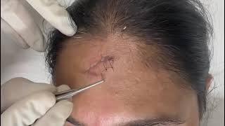 Right and easy way of suture removal [upl. by Ninazan]