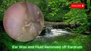 Jobson Horne Endoscopic Ear Wax Removal EAR CLEANING [upl. by Etirugram334]