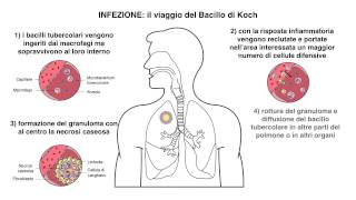 Video Patogenesi Tubercolosi [upl. by Hsejar872]