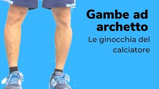 Gambe ad archetto gambe del calciatore o ginocchia vare [upl. by Nivlag]