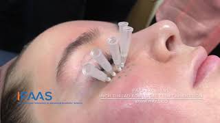 IFAAS Exclusive PDO Inch Thread for Under Eye Rejuvenation [upl. by Aro]