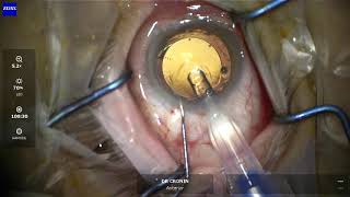 Secondary sulcus intraocular lens surgery explained for patients [upl. by Ailatan]