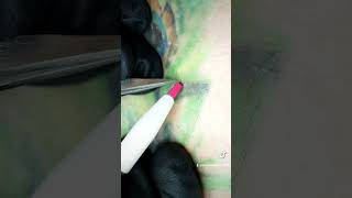 electrolysis hair removal [upl. by Dianthe122]