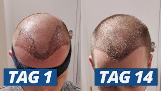 1  14 Tage nach Haartransplantation Der komplette Heilungsverlauf [upl. by Leahcimal]