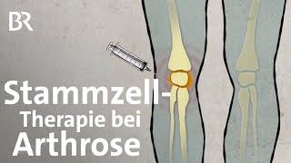 StammzellTherapie bei Arthrose Neue Behandlungsmethoden bei Knieschmerzen  Gut zu wissen  BR [upl. by Amabelle]