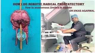 Robotic RADICAL PROSTATECTOMY urethrovesical anastomosis By DrVIKAS AGARWAL [upl. by Yarw]