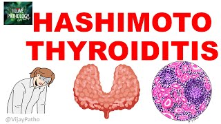 Hashimoto Thyroiditis Etiopathogenesis Gross m Microscopy and Clinical Features [upl. by Aniluj]