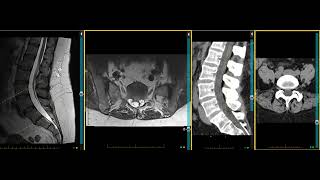 Multifidus muscle atrophy  CT and MRI comparison and the clinical progression in low back pain [upl. by Idnahk431]