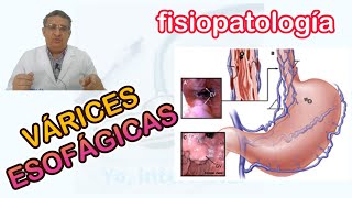 VARICES ESOFAGICAS FISIOPATOLOGIA [upl. by Mauve]