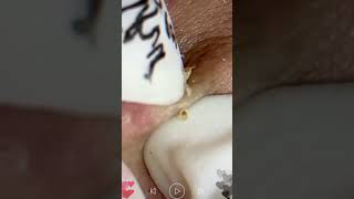 Skincare  Blackheads Removal 221 squeeze squeeze blackheads blackheads [upl. by Mackler]