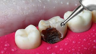 ASMR Restoration Incredible Tooth Cavity And The Master Dentist [upl. by Eadmund]