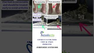 FOOT DEFORMATION CORRECTION footproblem deformationoffoot footandanklesurgeon footcondition [upl. by Timotheus]